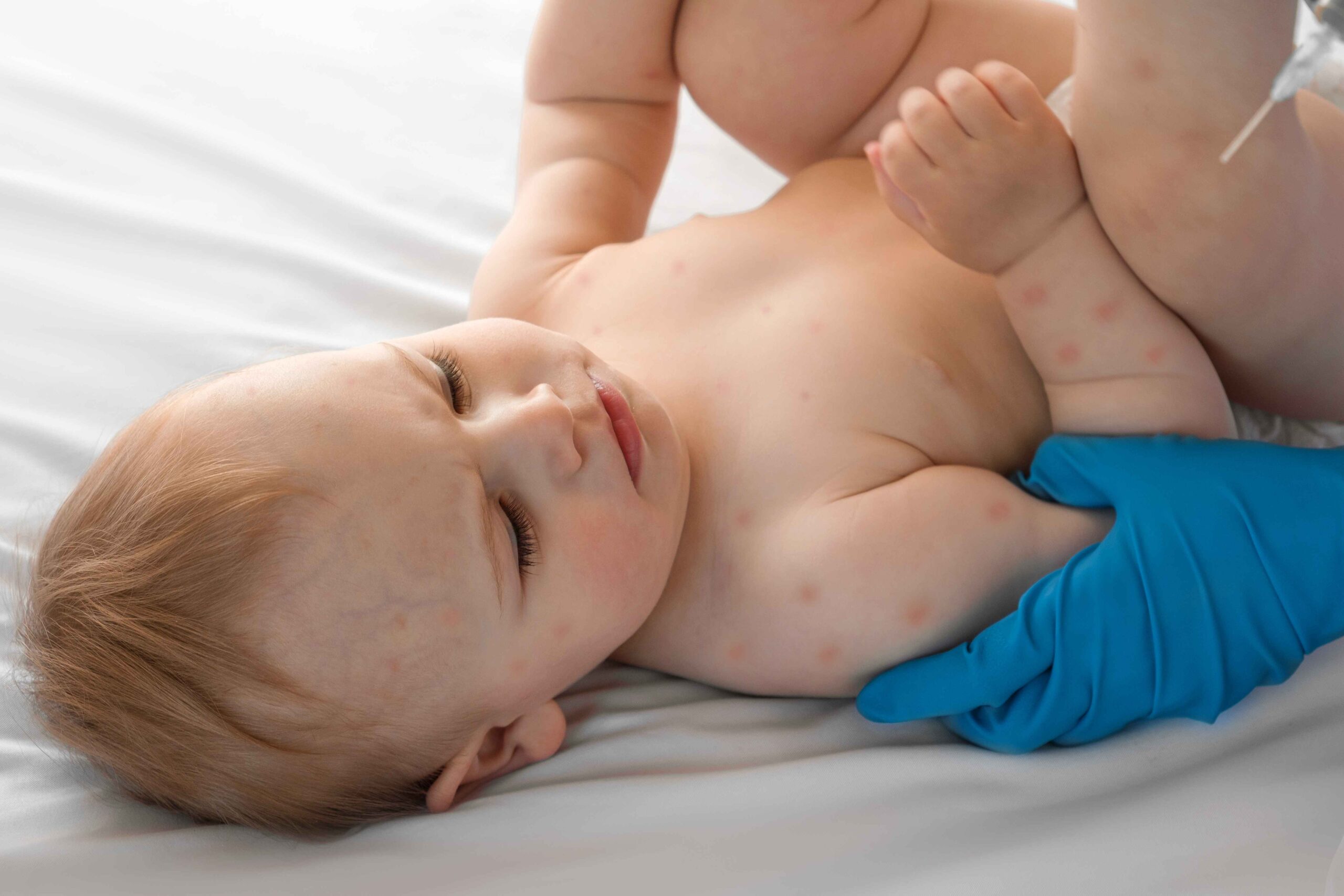 Jak wygląda ospa wietrzna u dzieci: przebieg choroby dzień po dniu